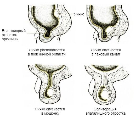 Продвижение яичка в мошонку и облитерация влагалищного отростка