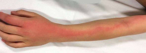 Лимфангит [14]