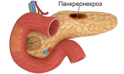 Панкреонекроз Панкреонекроз