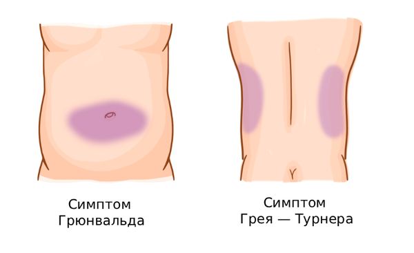 Специфические признаки панкреонекроза