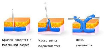 Флебэктомия Флебэктомия