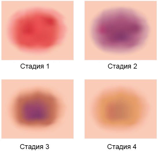 Симптом «цветения синяка» Симптом «цветения синяка»