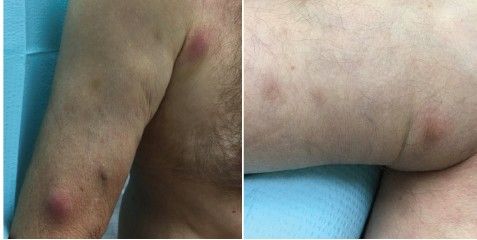 Узловатая эритема [19]