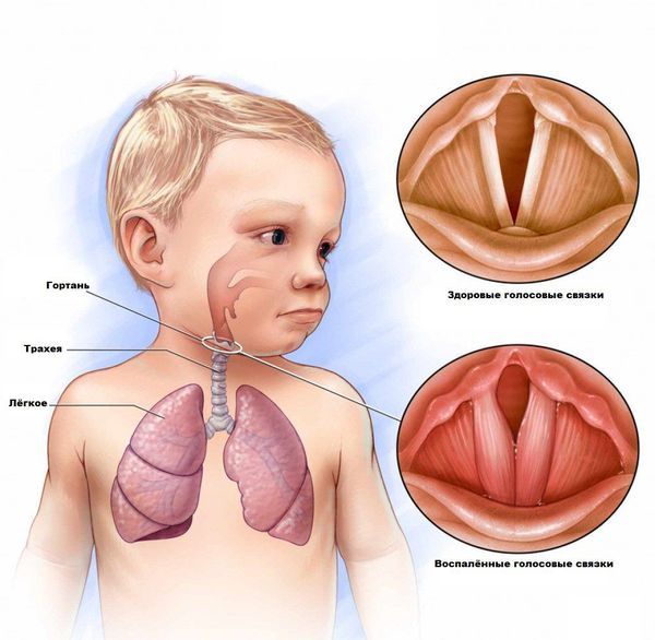 Гортань в норме и при ложном крупе (стенозе гортани) Гортань в норме и при ложном крупе (стенозе гортани)