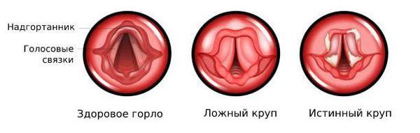 Здоровое горло, ложный и истинный круп