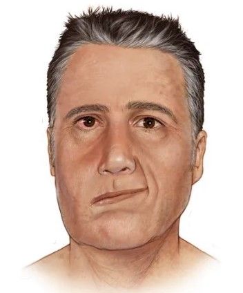 Паралич Белла