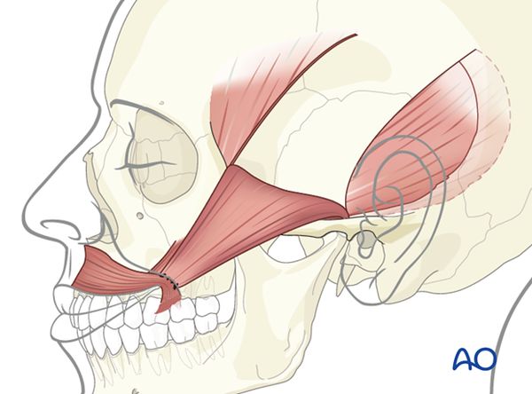 Транспозиция височной мышцы