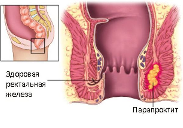 prostata ingrossata rimedi naturali Yatrynik a Prostatitis Vélemények