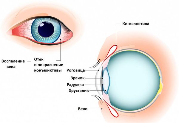 Воспаление конъюнктивы