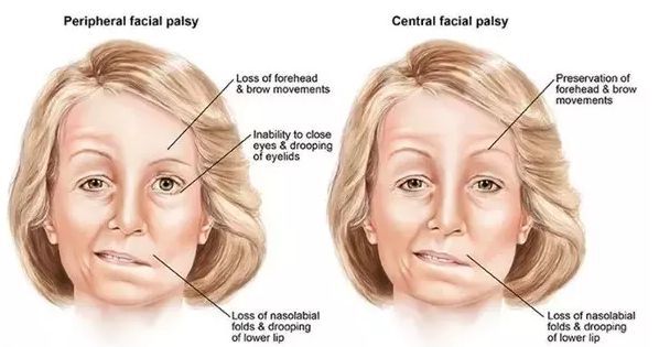 Периферический и центральный парез лицевого нерва