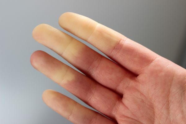 Болезнь Рейно Болезнь Рейно