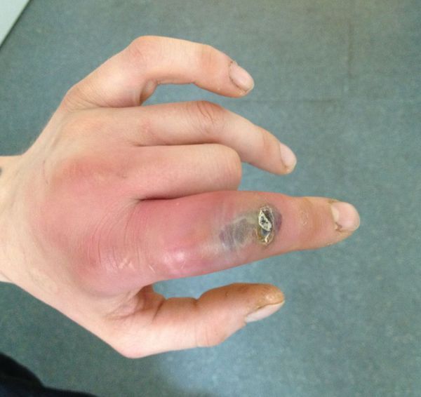 Флегмона [14]