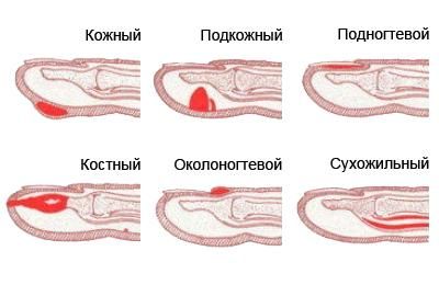 Виды панариция Виды панариция