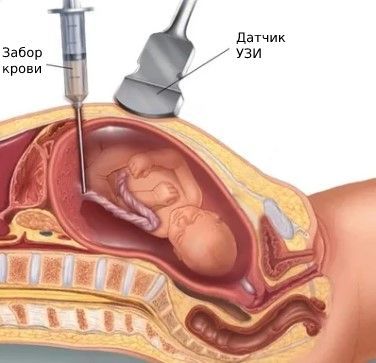 Кордоцентез