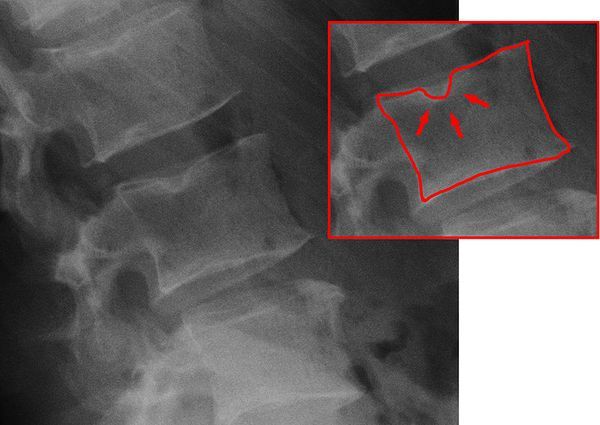 Грыжа Шморля [15]