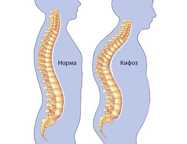 Патологический кифоз Патологический кифоз
