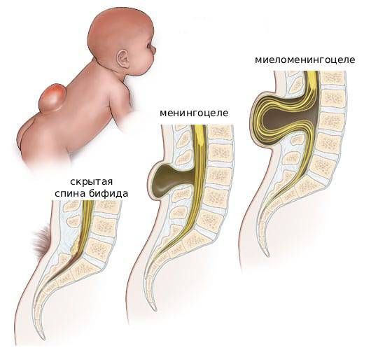 Спина бифида Спина бифида
