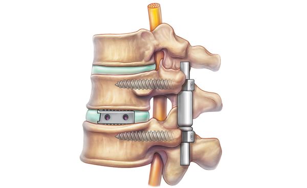 Спондилодез Спондилодез