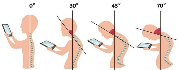 Степени кифоза Степени кифоза