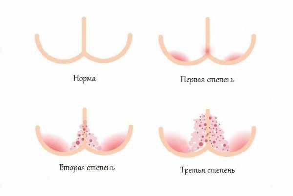 У новорожденного аллергия на все памперсы что делать