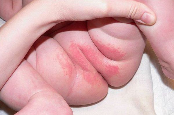 Воспаление кожи в области контакта с подгузником