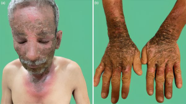 Пеллагра у человека с хроническим алкоголизмом [11]