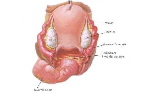 Пельвиоперитонит