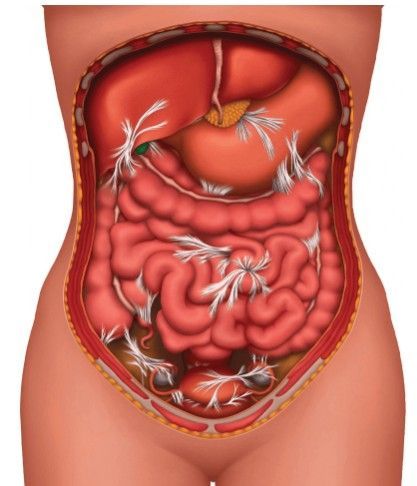 Спаечный процесс