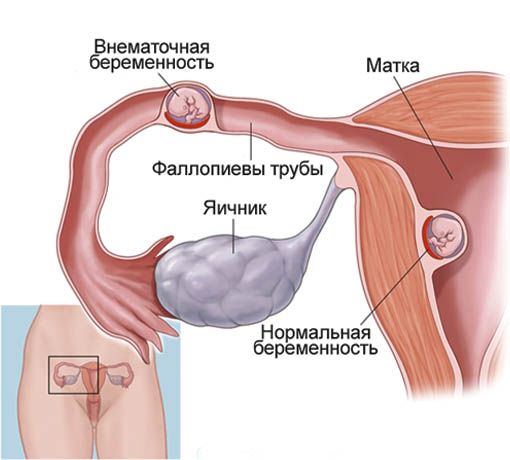 Внематочная беременность