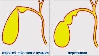 Перегиб и перетяжки желчного пузыря