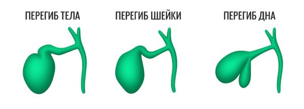 Разные виды перегибов желчного пузыря