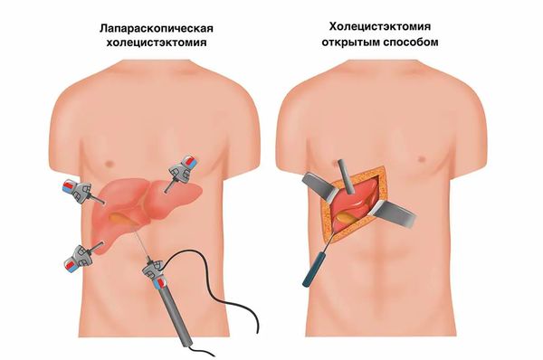 Виды холецистэкомии