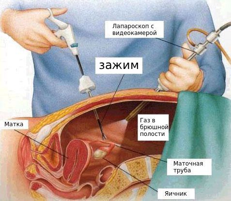 Лапароскопия