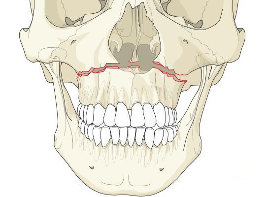 Нарушение анатомической целостности верхней челюсти