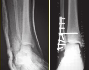 Накостный остеосинтез [16]