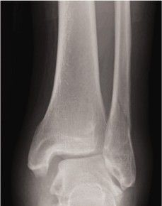 Перелом лодыжки типа B. Правая нога, вид сзади [17]