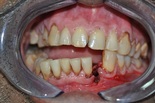 Неполное смыкание зубов при переломе нижней челюсти