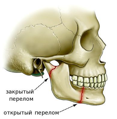 Открытый и закрытый перелом нижней челюсти
