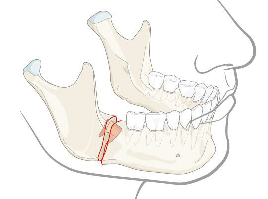 Перелом нижней челюсти с вовлечённым зубом