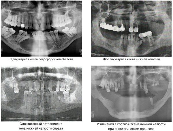 Причины патологического перелома нижней челюсти