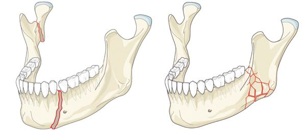Варианты перелома нижней челюсти