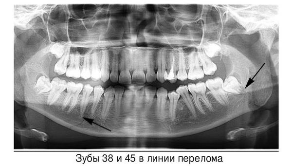 Зубы, расположенные на линиях перелома