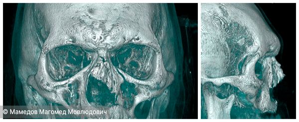 3D КТ носа и околоносовых пазух: посттравматическая деформация наружного носа после полученной спортивной травмы. Вид спереди и сбоку