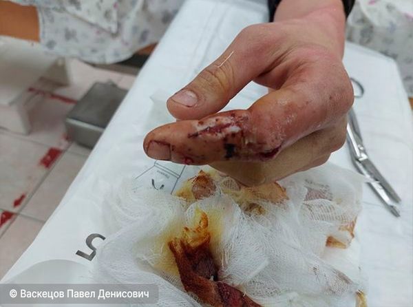 Инфекционно-воспалительный процесс при переломе пальца руки