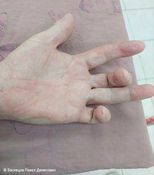 Контрактура сустава