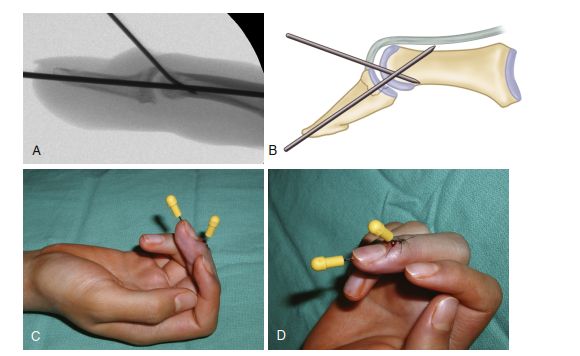 Лечение перелома средней фаланги безымянного пальца кисти спицами Киршнера [6]