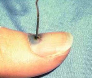 Лечение подногтевой гематомы [5]