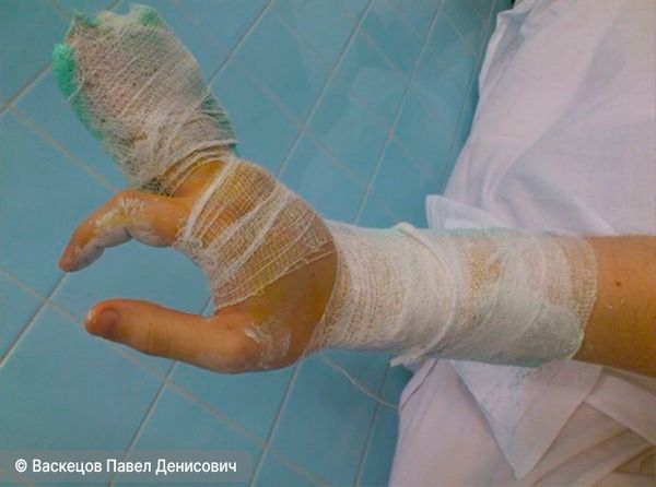 Недопустимая фиксация при переломах пальцев кисти