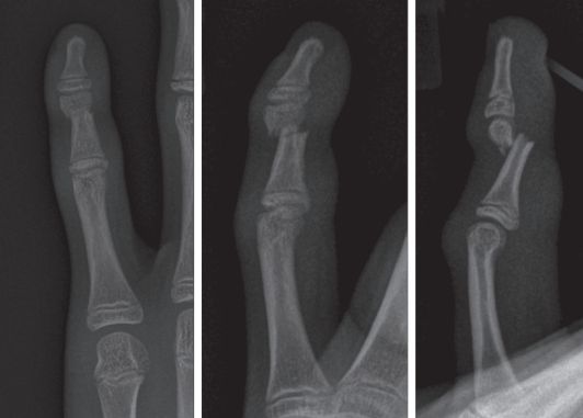 Непрямой перелом пальца руки [6]