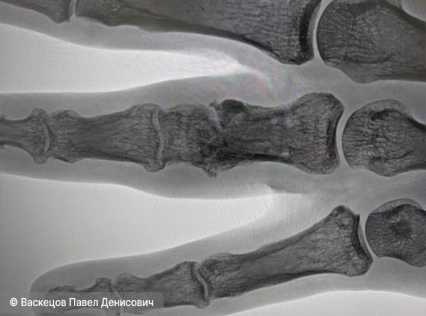 Несращение кости